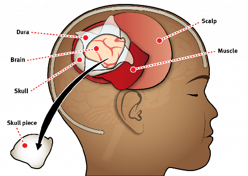 craniotomy-treatment-getwellgo-india-s-best-healthcare-services